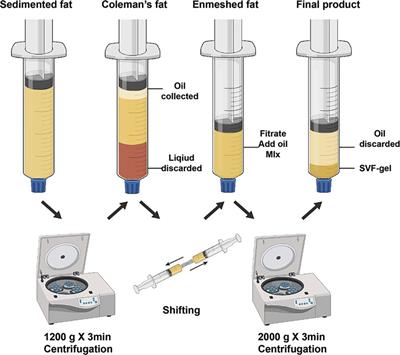 Contouring and augmentation of the temple using stromal vascular fraction gel grafting